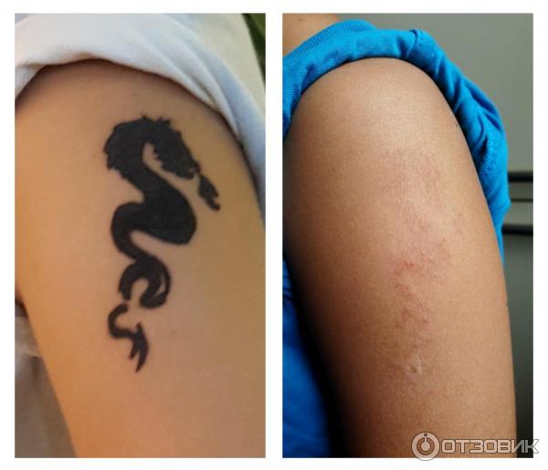 Как избежать аллергии на татуировку?