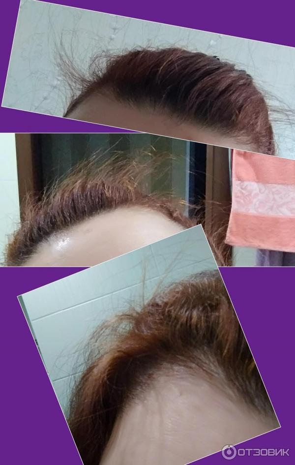 Восстановление густоты волос отзывы. Лосьон для волос от выпадении до и после. Селенцин от выпадения волос до и после. Селенцин пептидный лосьон. Андрогенная алопеция Селенцин.